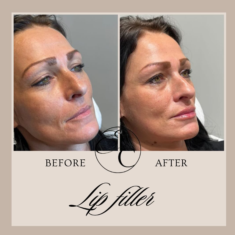 Lipfillers