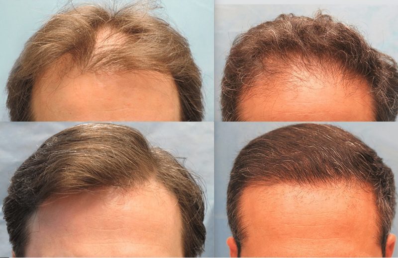 Fue hair restoration